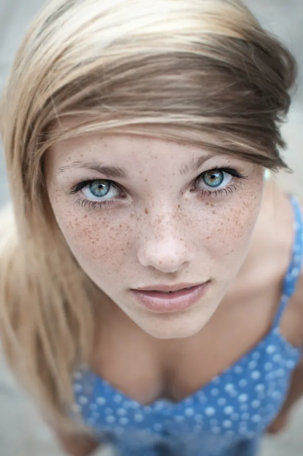 freckles