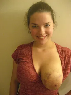 brynn bruised tits